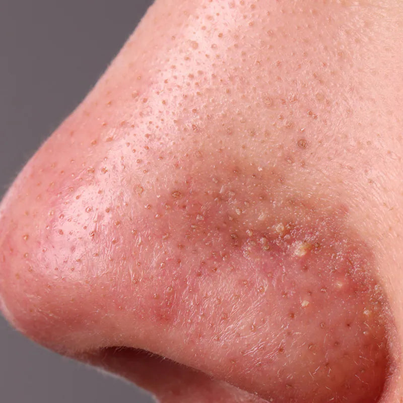 鼻头白点是粉刺还是皮脂管丝？要清吗？怎么清？减少皮脂管丝3大关键